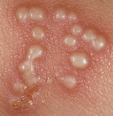 Illustration for article titled Obat Herpes